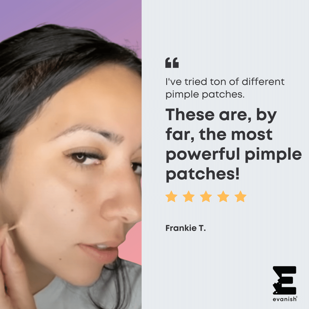 4 Reviews at Evanish Skincare describe that these are by far the most powerful pimple patches